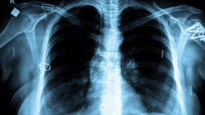 Tuberculosis-TB-in-Nepali-1711118034.jpg